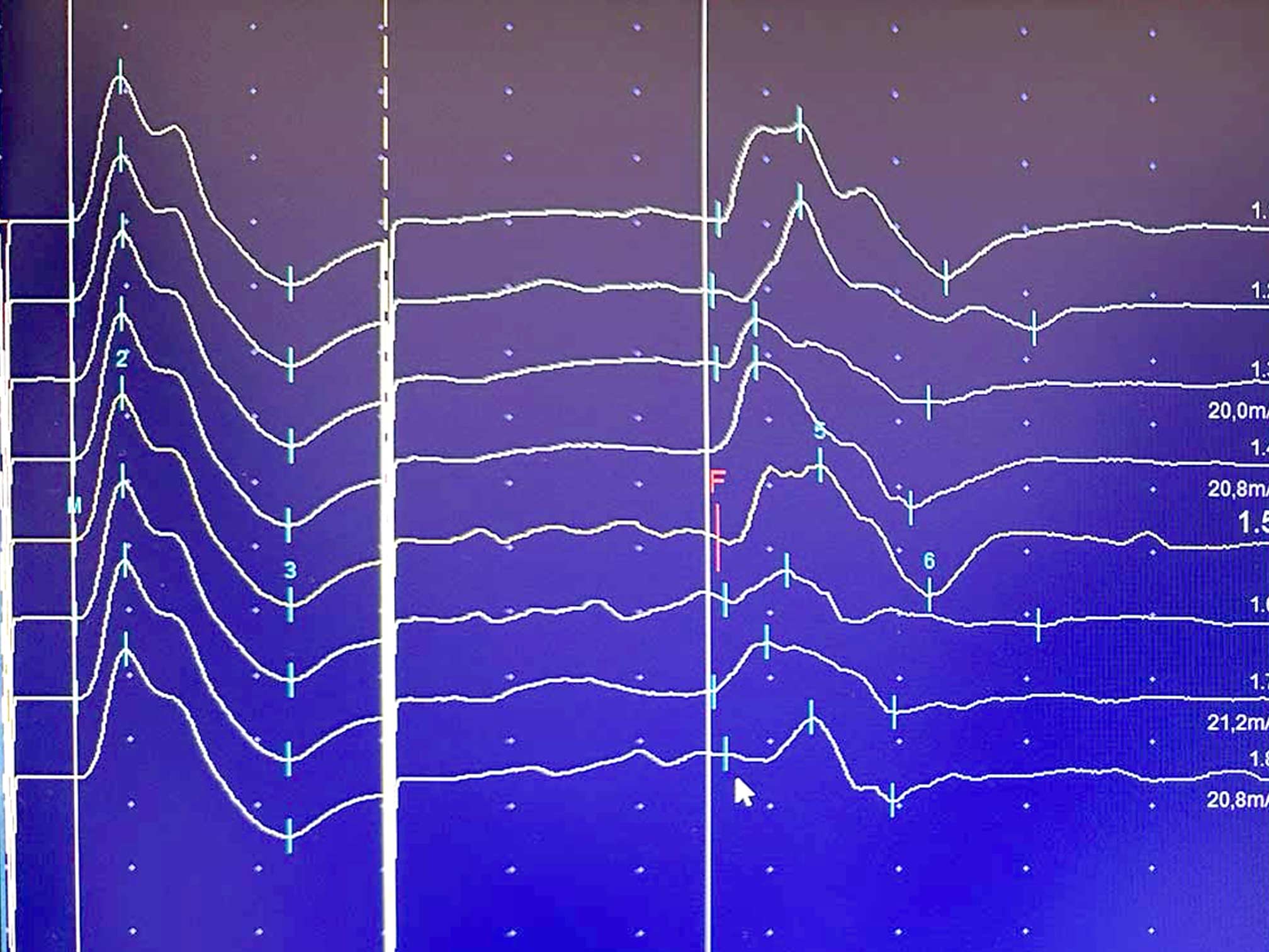 esame neurofisiologico bambini